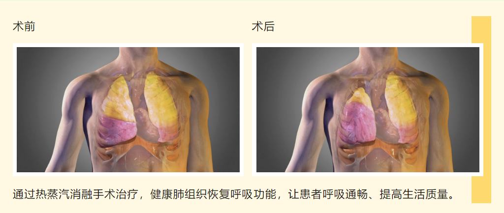 支气管镜“蒸汽盾”激活肺动力——91porn
开展靶向热蒸汽消融术，让慢阻肺患者告别“窒息人生”